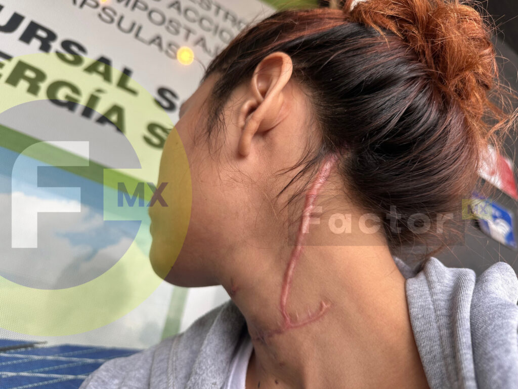 Daniela fue víctima de intento de feminicidio en Toluca y muestra sus cicatrices.